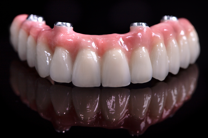 Implant-Supporten-Denture_WEB Implant-Supporten-Denture_WEB