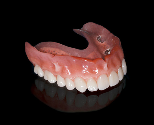 Implant-Retained-Denture_WEB Implant-Retained-Denture_WEB